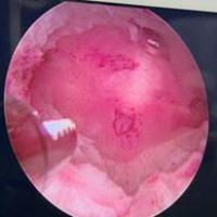 Multiple_Polyps_AfterRemoval