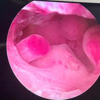 Multiple_Polyps_Before_Removal